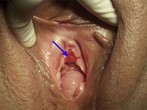 Metástasis en introito vaginal de ACA de endometrio.