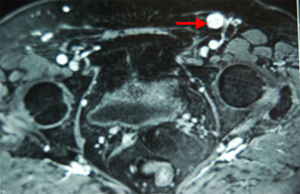 RM pélvica (secuencia T1 axial con contraste). Podemos ver adenopatía inguinal izd. de 2cm.