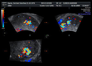 Imagen con Doppler color miometrial formando un mosaico con alta velocidad de flujo y bajo índice de resistencia, sugestiva de malformación arteriovenosa.