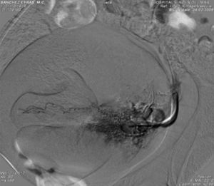 El angiograma postembolización muestra la oclusión de la arteria uterina izquierda, con extravasación del material de contraste.