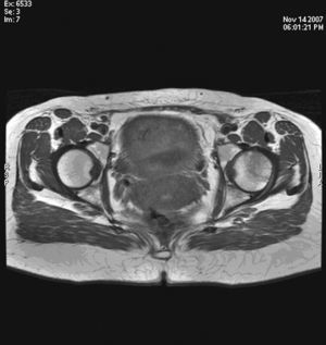 Resonancia magnética de cadera izquierda (T1). Hipointensidad en la cabeza femoral izquierda. La imagen muestra edema en la médula ósea con cortical conservada.