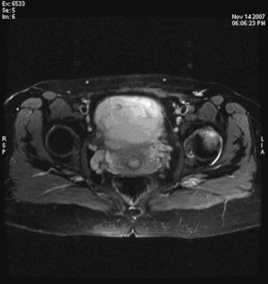 Resonancia magnética de cadera izquierda (T2). Hiperintensidad de cabeza femoral izquierda. La imagen muestra edema en la médula ósea con cortical conservada.