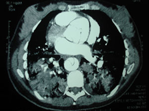 Tomografía computarizada de la disección a nivel de aorta ascendente.