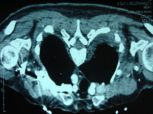 Tomografía computarizada de la disección que afecta a los troncos supraaórticos.