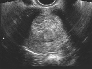 Imagen ecográfica de mioma intramural heterogéneo de 7cm que contacta y desplaza la línea endometrial posteriormente.
