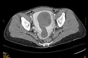 Tomografía computarizada pélvica donde se visualiza un mioma que ocupa toda la luz uterina y se extiende hacia el cérvix.