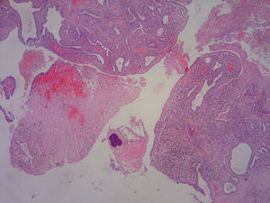 Se identifica parte de la mucosa de la trompa con marcados cambios reactivos. Presencia a nivel de la luz de colonias de gérmenes tipo actinomices (preparación con hematoxilina-eoxina).