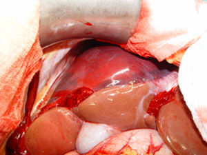 Coágulo subcapsular hepático de 15cm y rotura de Glisson sobre segmento V.