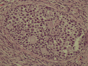 Grandes nidos circunscritos compuestos por una mezcla aleatoria de células grandes germinales y células pequeñas de los cordones sexuales.