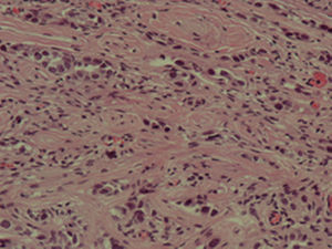 Células germinales infiltrando el estroma ovárico fuera de los nidos de gonadoblastoma.