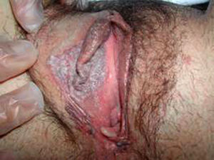 Lesión vulvar en el labio mayor derecho.
