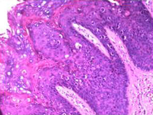 Imagen histológica (HE X40). Carcinoma epidermoide in situ (neoplasia vulvar intraepitelial) con atipias queratinocíticas pagetoides en todo el grosor del epitelio.