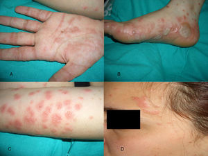 A: lesiones pápulo-vesiculosas en la palma de mano. B: grandes ampollas en cara lateral de los pies. C: lesiones vesiculosas agrupadas sobre base eritematosa en antebrazos. D: lesiones en cara.