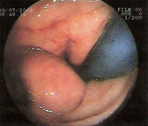 Colonoscopia: protusión a nivel rectal de una masa extrínseca de posible origen ginecológico.