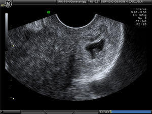 En la ecografía se visualiza el canal cervical dilatado, en el que se observa un saco gestacional con una embrión vivo con una circunferencia cráneo caudal de 6mm y desarrollo habitual a las 6 semanas.