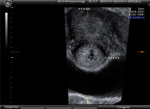 En la eco en 3D se observa la vesícula gestacional alojada en el cérvix uterino, con el embrión en su interior.