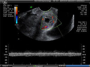 Se observa el cérvix uterino dilatado con un área anecoica rodeada de un halo hiperecogénico con Doppler color positivo y con índice de resistencias bajas, sugerente de embarazo ectópico cervical.