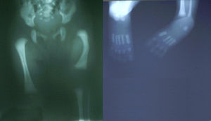 Caso 2: radiografía de las extremidades inferiores del neonato.