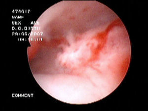 Adenocarcinoma de origen intestinal en el fondo de saco posterior visible con vaginoscopia.