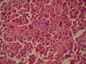 Zona infiltrante del melanoma con células de patrón epitelioide, marcado pleomorfismo nuclear, nucleolos prominentes y figuras de mitosis (hematoxilina-eosina, 400×).