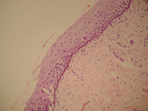 Epitelio escamoso vaginal con frecuentes melanocitos, abundante pigmento en la zona basal e hiperplasia melanocítica (hematoxilina-eosina, 100×).