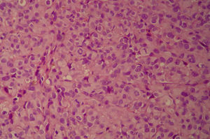 Imagen microscópica del melanoma cervical, con elevado índice mitótico (6 mitosis por campo de gran aumento).