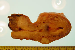 Pieza quirúrgica del útero con el melanoma en su cérvix.