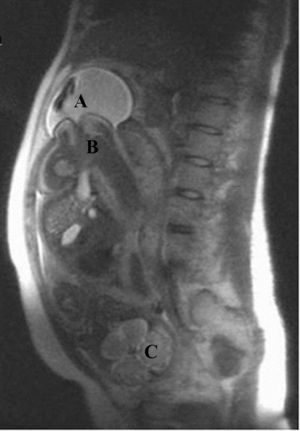 Resonancia magnética, plano sagital. A) Eventración de bolsa amniótica. B) Polo podálico fetal. C) Polo cefálico fetal.