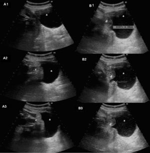 Ecografía obstétrica. Secuencia de eventración de partes fetales por defecto uterino. A) Bolsa amniótica. B) Flechas: bordes de defecto uterino. C) Polo podálico fetal. D) Testículos fetales.