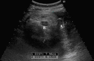 Ecografía obstétrica. Corte transversal del defecto. A) Testículos fetales. B) Ano fetal. Cursores: bordes del defecto.