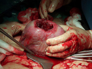 Detalle del defecto tras extracción fetal.