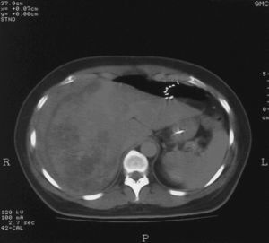 Tomografía computarizada posterior a la realización de la cesárea, corte caudal.
