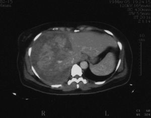Tomografía computarizada posterior a la cesárea, corte superior.