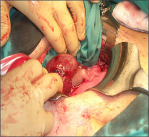 Rotura del anejo derecho y salida del feto a través de la trompa.