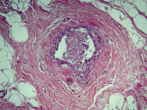 Carcinoma intraductal no de alto grado nuclear, con necrosis de tipo comedo (HE, x200).