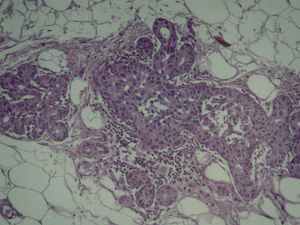 El tumor se origina en la unidad ducto-lobulillar terminal y muestra cancerización de lobulillos (HE, x200).