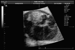 Ecocardiografía fetal, corte de 4 cámaras: Tumoración redondeada de aspecto predominantemente sólido, que mide aproximadamente 2 centímetros y que parece depender de la aurícula derecha.