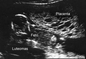 Ecografía transabdominal donde se identifican los tres componentes de la mola parcial: feto, placenta de gran tamaño con múltiples cavidades quísticas en su interior y luteomas.