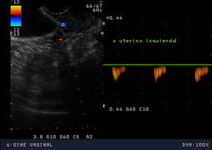 Estudio Doppler de vascularización en arteria uterina izquierda.