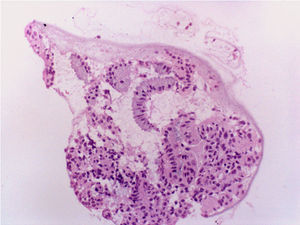 Biopsia endometrial mostrando exclusiva representación de glándulas endocervicales. Hematoxilina-Eosina 250 x.