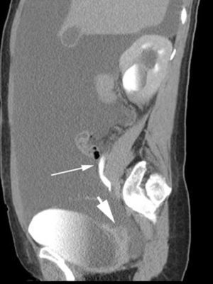 Reconstrucción sagital de TAC multicorte tras administración de contraste: se evidencia el “jet” de la fístula ureteral (flecha fina) y extravasación de contraste (flecha gruesa).