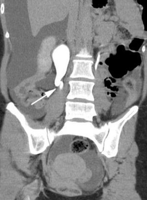 Reconstrucción coronal de TAC multicorte donde se observa dilatación proximal de uréter derecho.