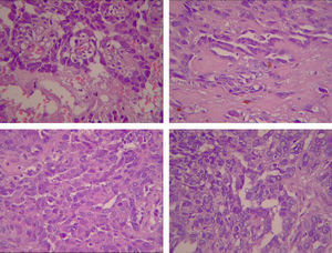 Neoplasia maligna con diferentes áreas de patrón adenocarcinomatoso, pobremente diferenciadas y anaplásicas (HE 40X).