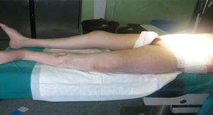Hipoplasia de los músculos de las piernas. Cicatrices por cirugía previa en ambas tibias con osteosíntesis.