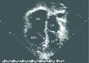 Ejemplo de un ecocardiograma (corte de 4 cámaras, ápex inferior) de una paciente con enfermedad de Ebstein severa, en el que se demuestra una valva septal severamente desplazada. La valva anterior está fijada y casi inmóvil. El ventrículo derecho funcional (VD) es pequeño. ARV: ventrículo derecho auricularizado; LA: aurícula izquierda; LV: ventrículo izquierdo; RA: aurícula derecha.