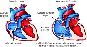 Esquema de la anomalía de Ebstein.