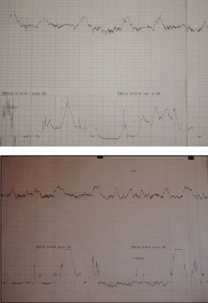 Registro cardiotocográfico el día en que la paciente se puso en trabajo de parto.