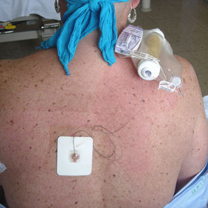 Bloqueo paravertebral torácico izquierdo con catéter y bomba elastomérica.