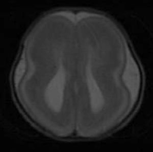 RM posnatal: morfología «en ocho» del parénquima cerebral. Ventriculomegalia bilateral.