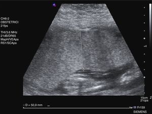 Placenta engrosada en la semana 26.